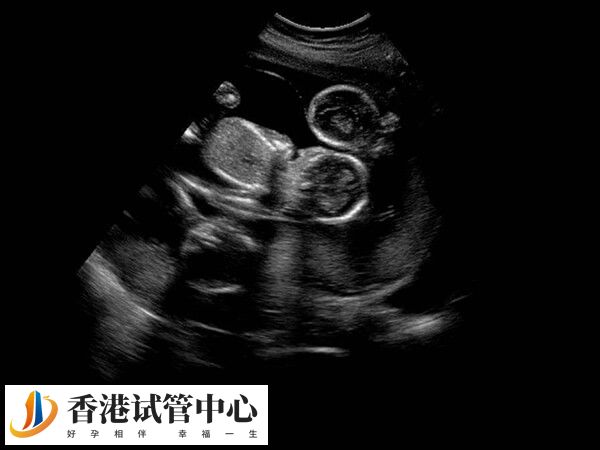 孕12周前孕妇要警惕胎停的情况